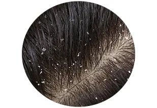 Dandruff treatment items - Keya Seth Aromatherapy
